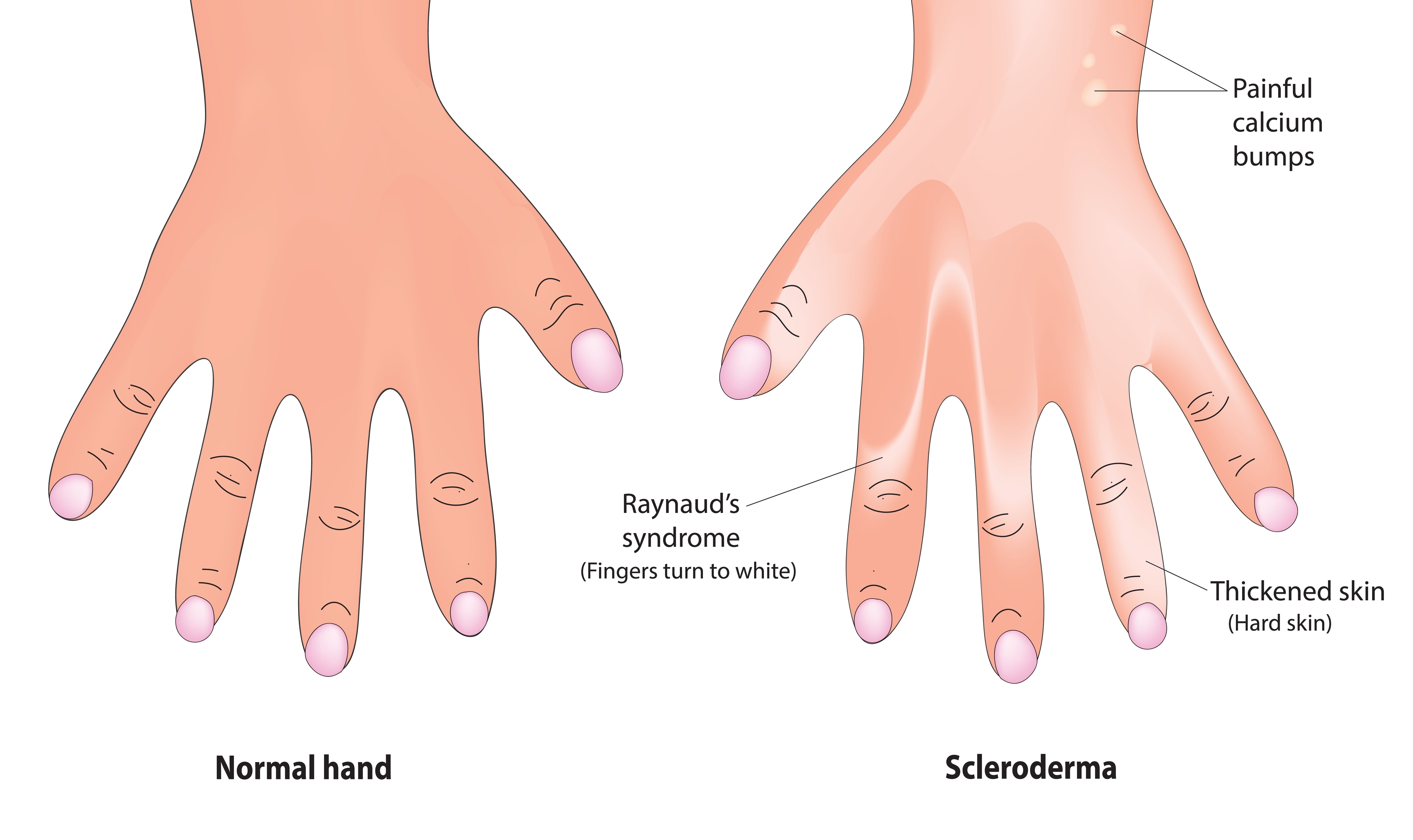 sindrom_Raynaud_maini